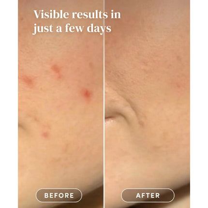 Apricot Beauty Post Pimple Patches