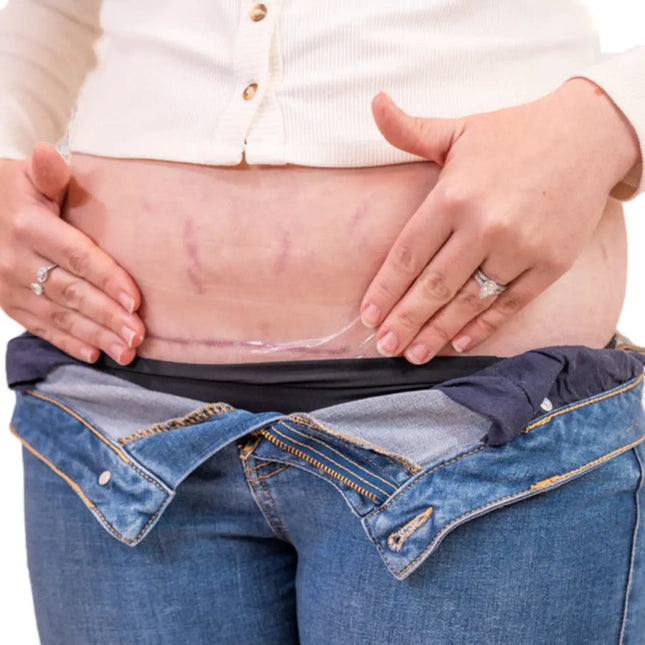 Booby Tape Tape Silicone Scar Patches