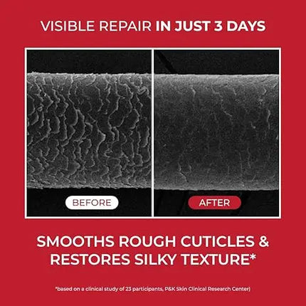 Moev Annurcatin Treatment